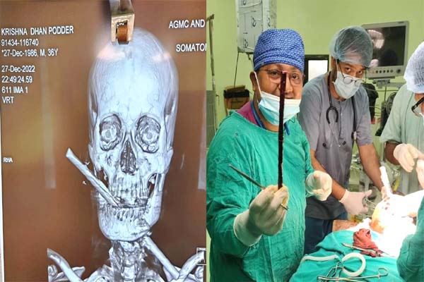 Tripura doctors perform critical surgery, CM hails
