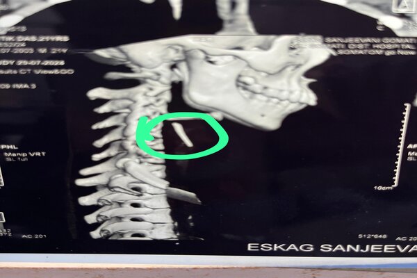 4-inch chicken bone stuck in pyriform sinus: Tripura youth gets second life